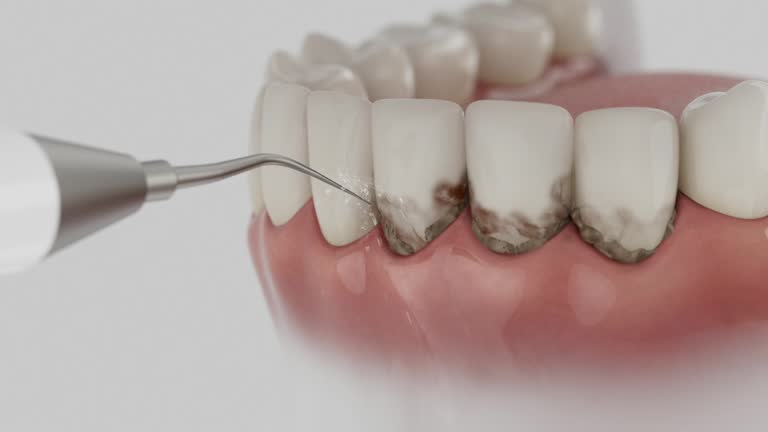 Trusted Wisdom Tooth Removal service in Sandusky, MI - Dentist Open Now